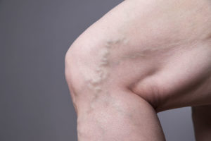 Obesity & Vein Treatment | Tampa Vein Specialists