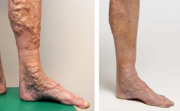 tampa vein specialist recovery