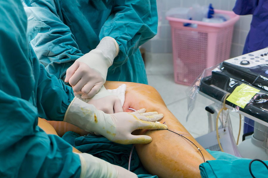 bigstock-164396309 Microphlebectomy