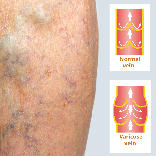 varicose veins 