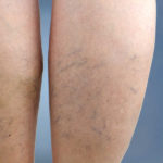 Venous insufficiency