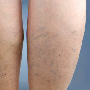 varicose veins