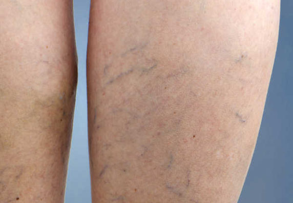 varicose veins