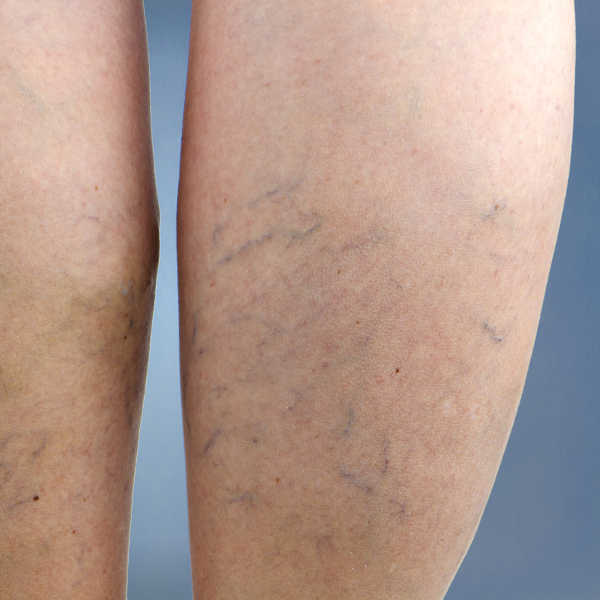 varicose veins