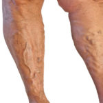 Venous insufficiency