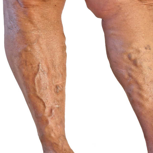 varicose veins