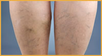 vein treatment