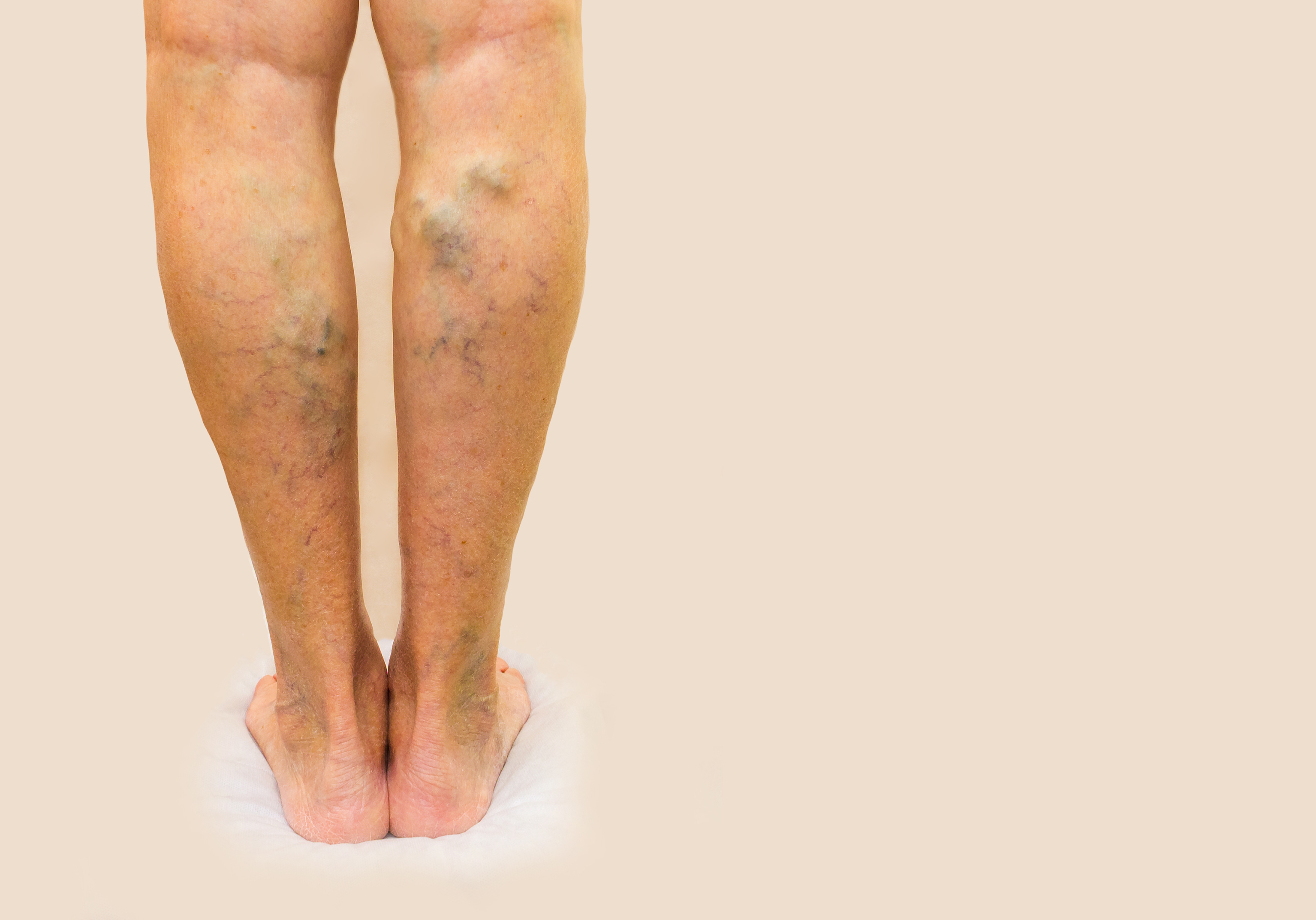 venous insufficiency