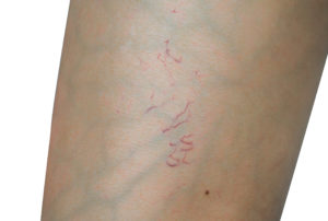 spider veins